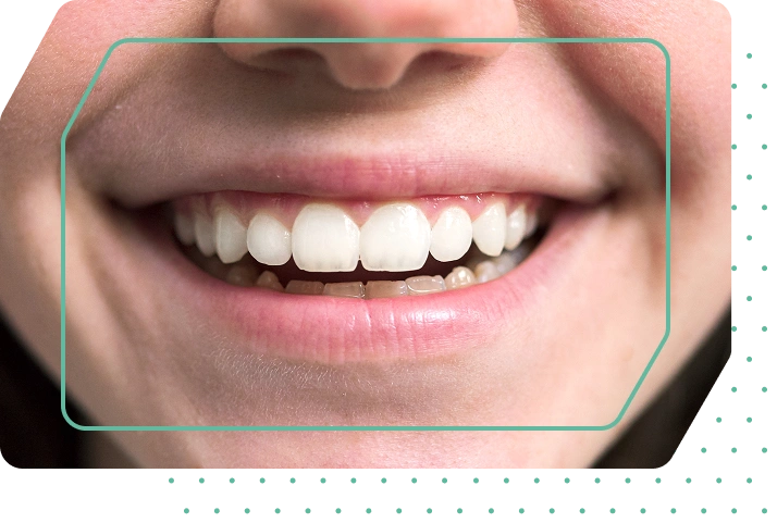 Smile with corrected tooth gap